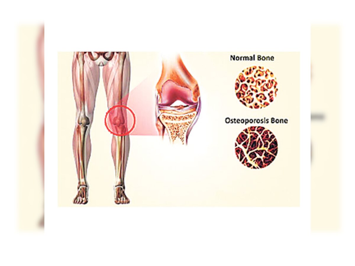 Porous bones, a serious threat or a strategised hype!