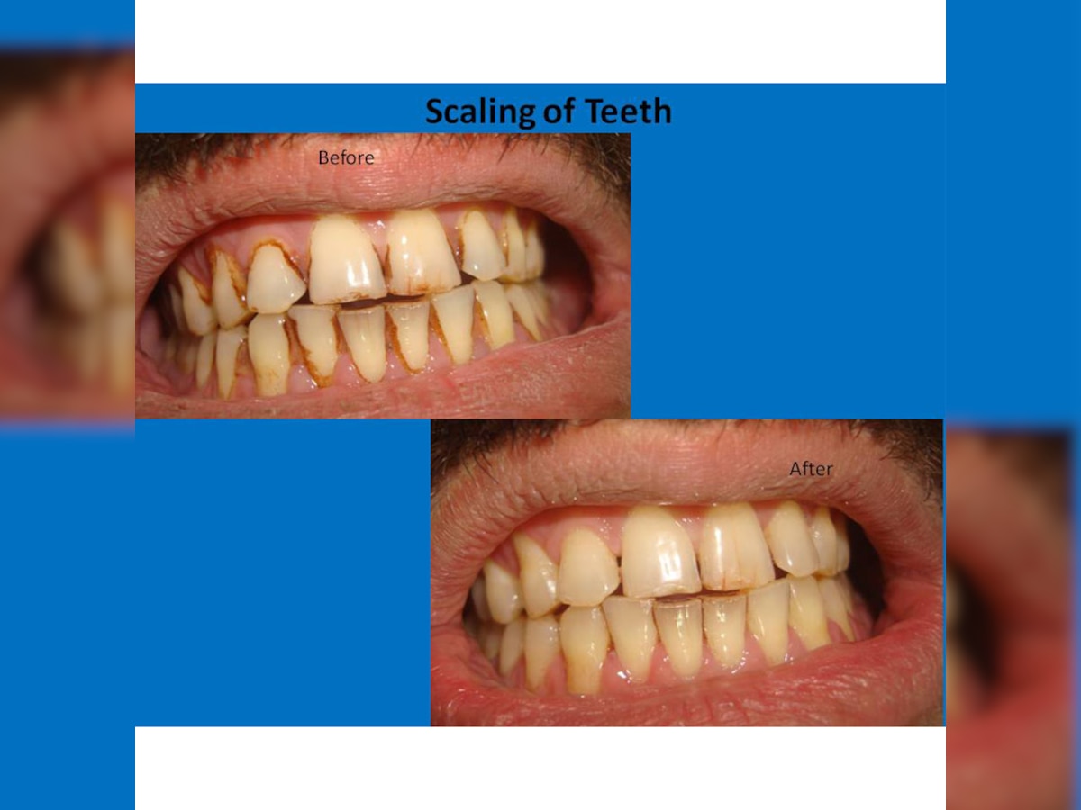 Everything you need to know about teeth scaling