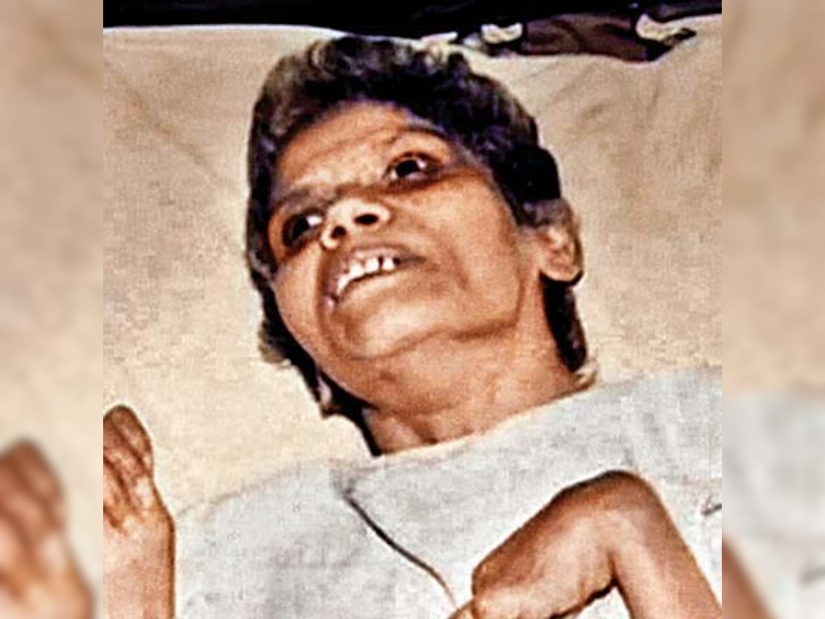 Nurse Aruna Shanbaug, in vegetative state for 42 years after rape, now on ventilator