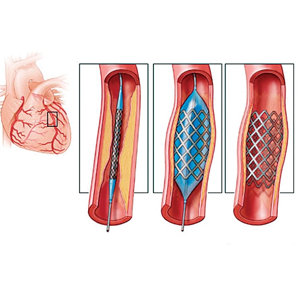 Cardiac stents likely to be made more affordable