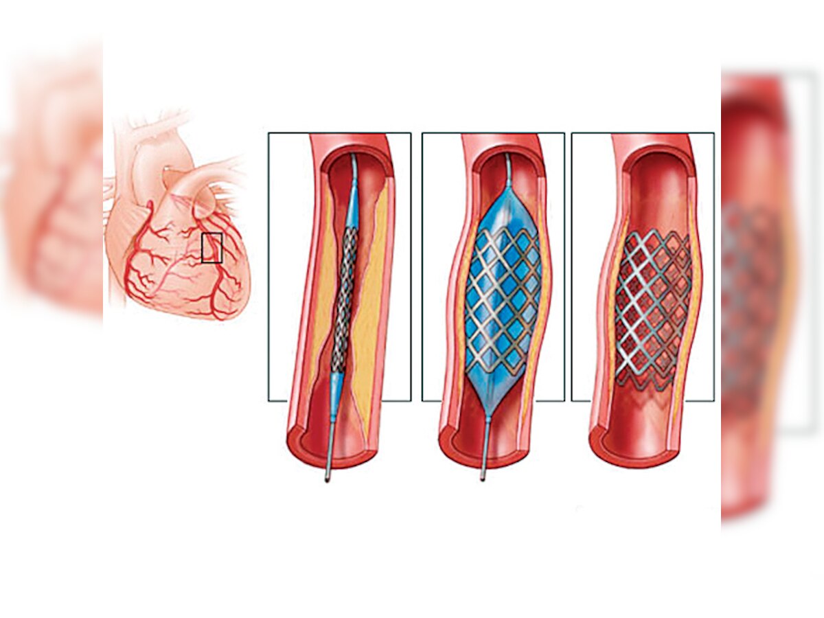 Cardiac stents likely to be made more affordable