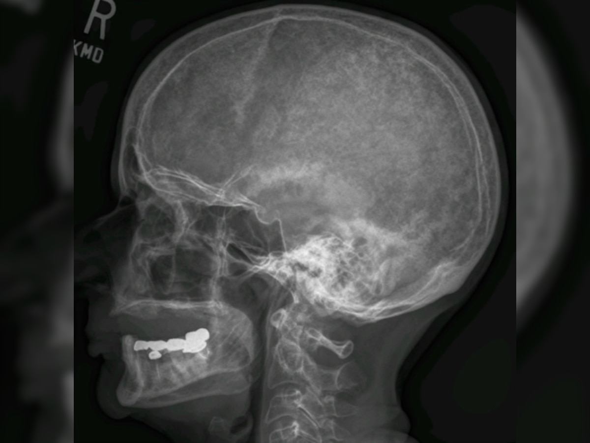 NASA helps develop osteoporosis and bone cancer test