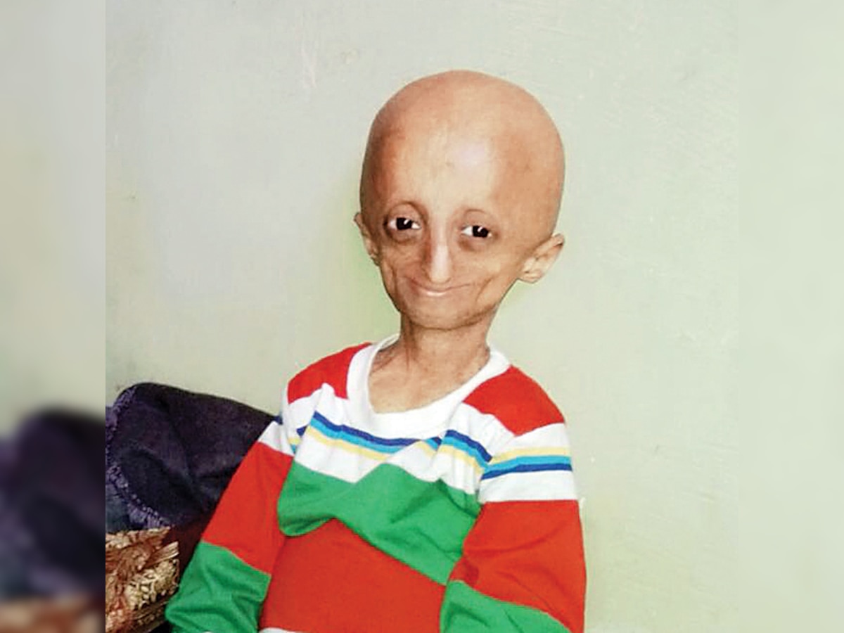 Mumbai boy avails the only known treatment for progeria in Boston