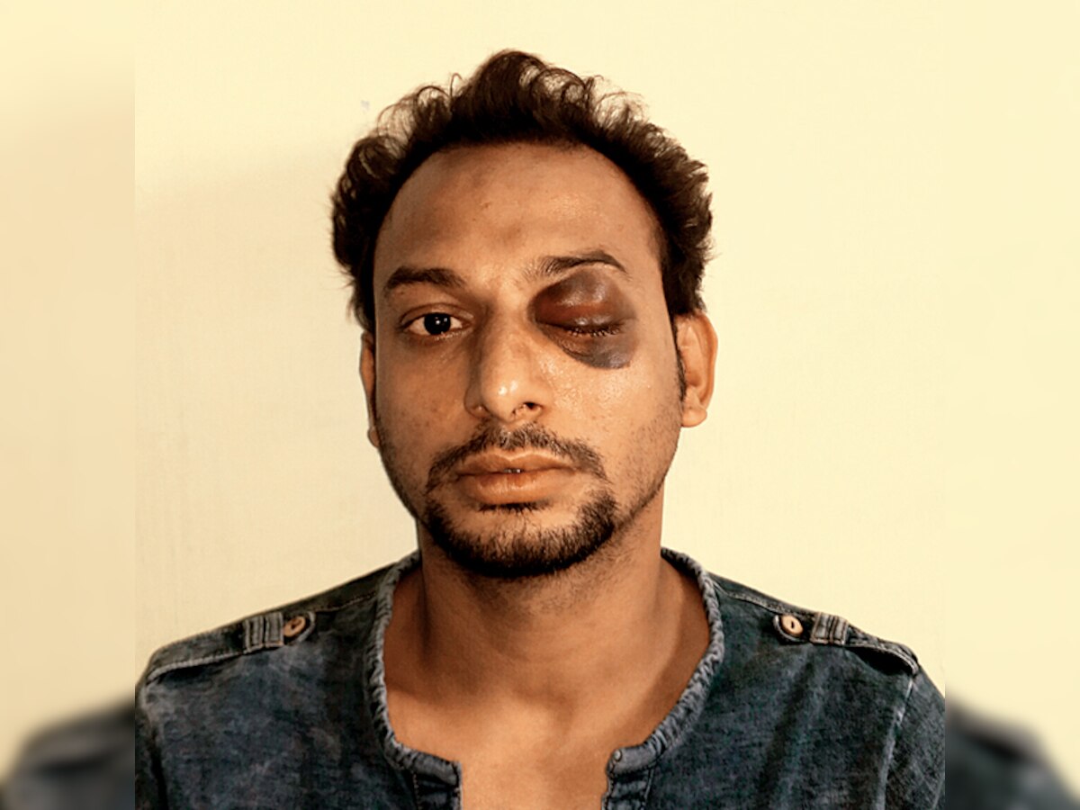 Youth thrashed during birthday celebration, may lose eye