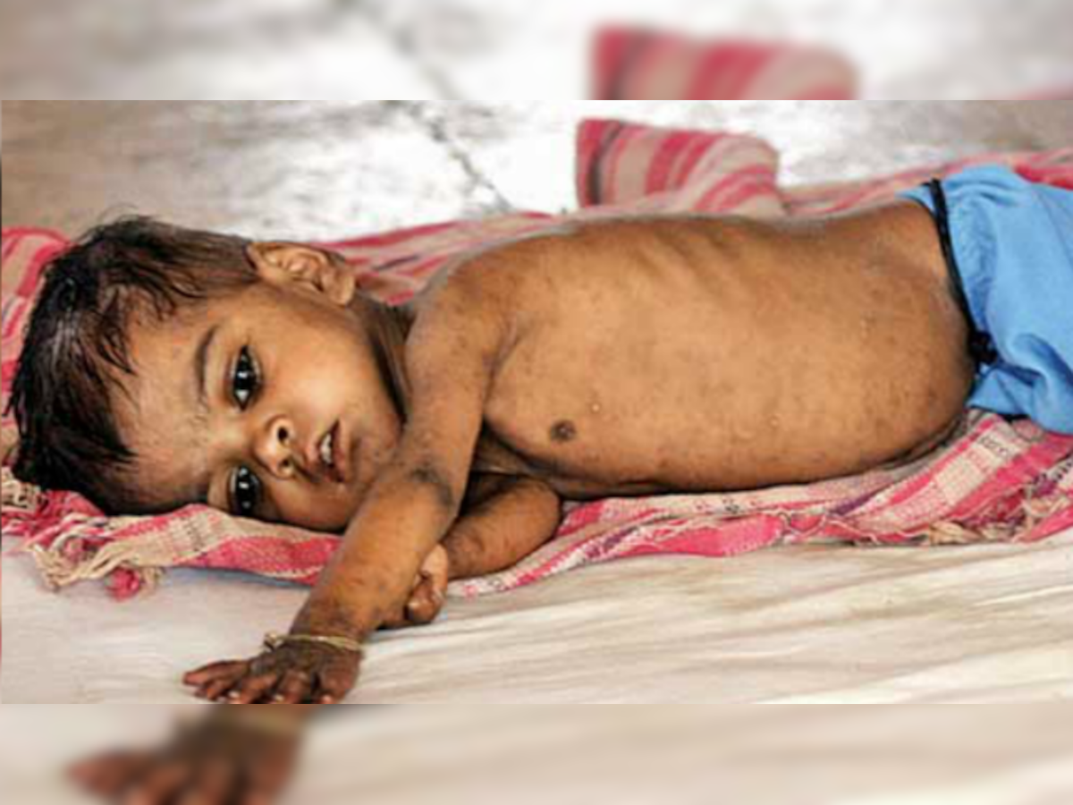 One in every two children in West Bengal anaemic: NFHS