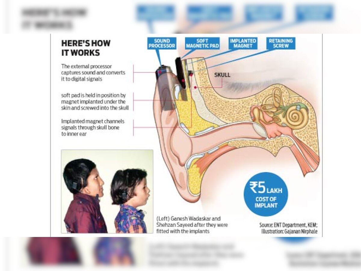 Latur farmer's boy among 2 kids to get a new ear