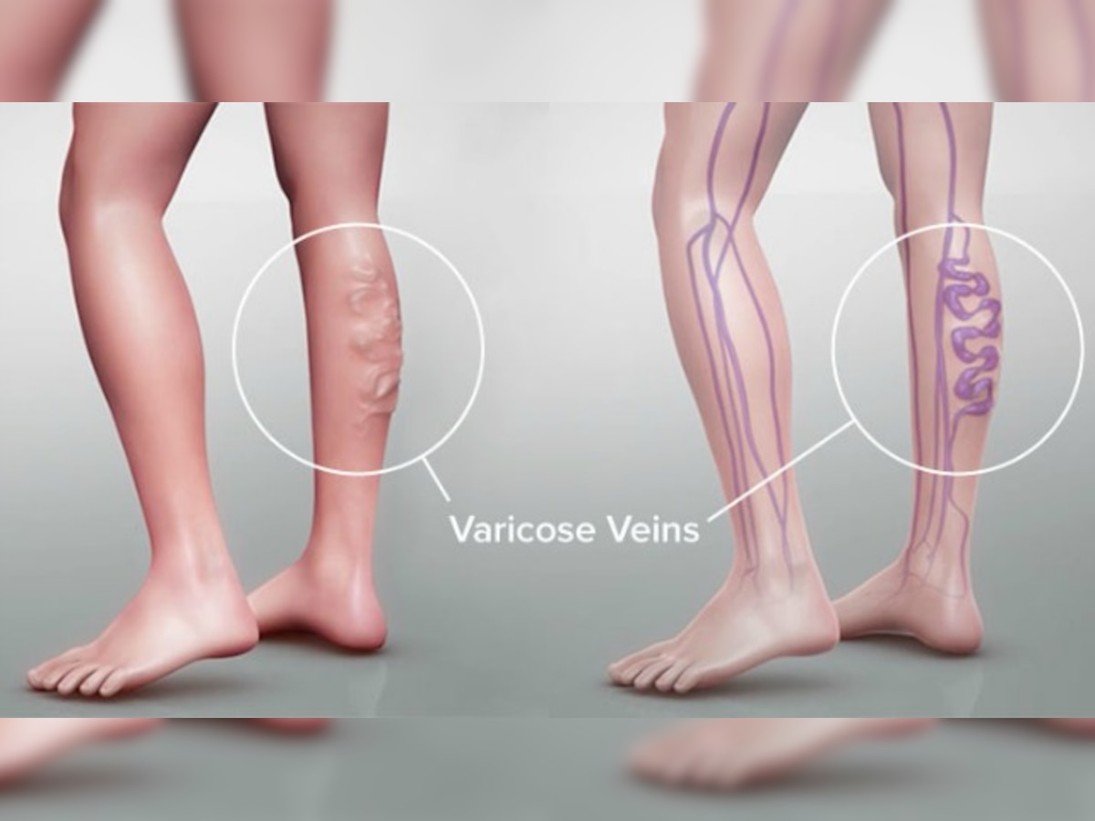 Medanta  How to Prevent Varicose Veins: Lifestyle Changes and