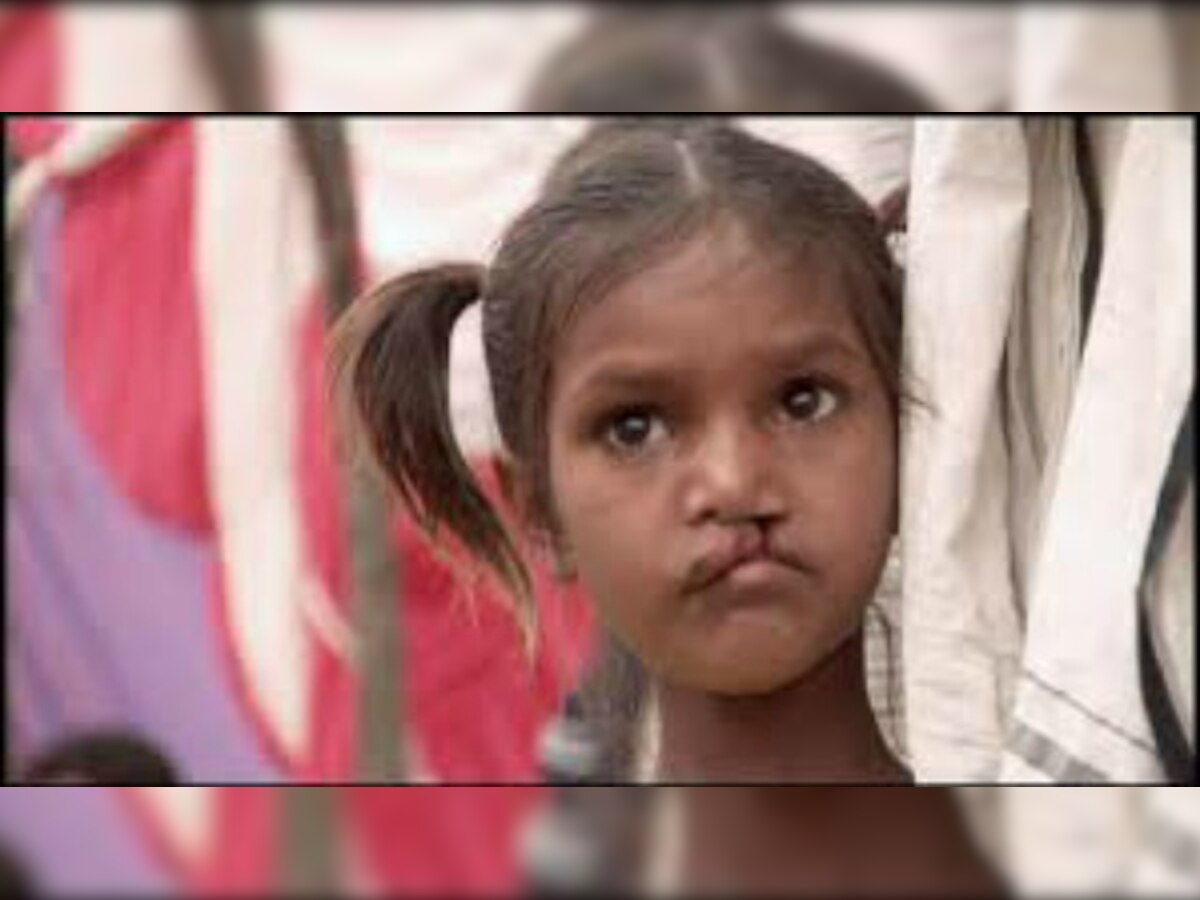 India has over 72,000 cases of unrepaired cleft lip, palate