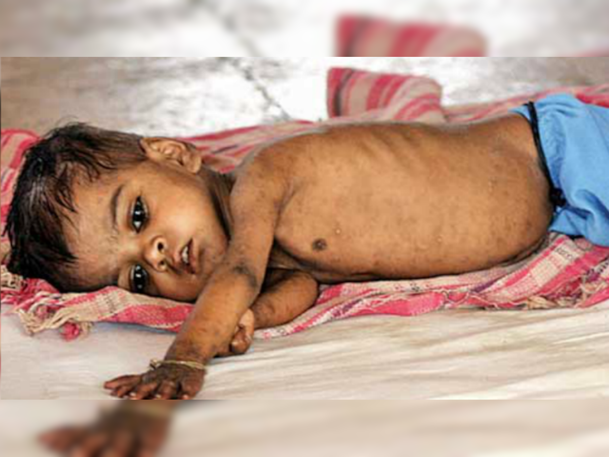 Too fat, too thin - malnutrition fuels disease worldwide 