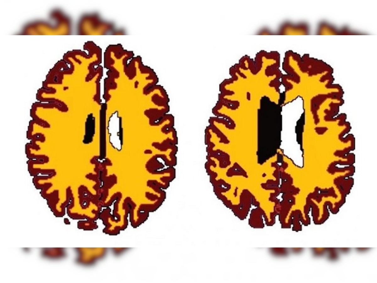 Obesity ages your brain, claims new study