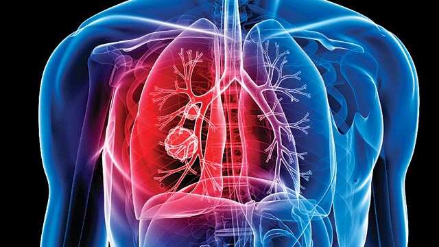 TB patients in India could be much higher: Study TB patients in India could be much higher: Study