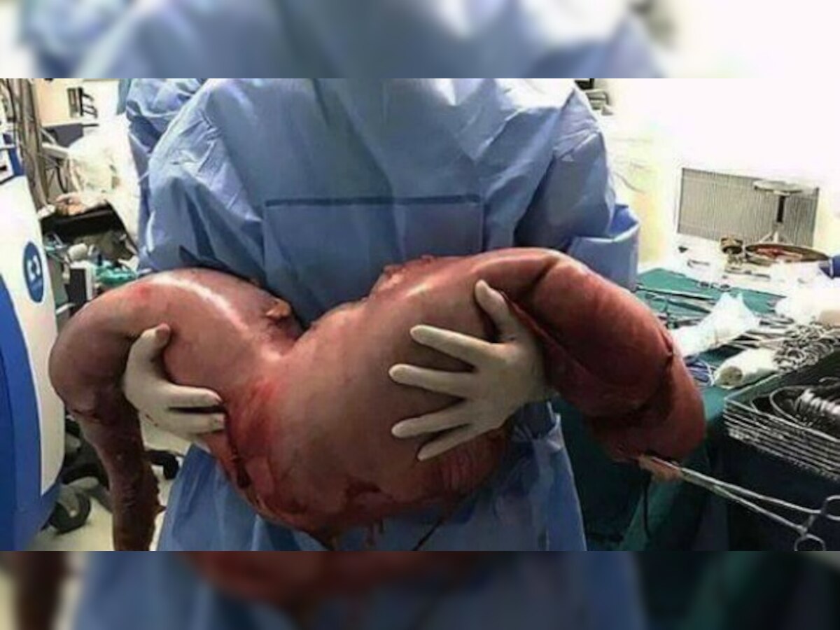 China: Doctors remove 13 kg of faecal matter from 22-year-old man constipated since birth