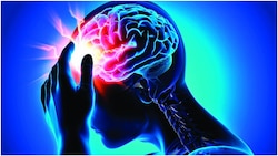 Brain stroke on the rise among youths: Experts