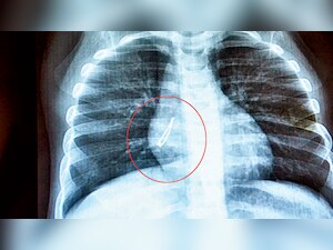 LED bulb found in baby's lung