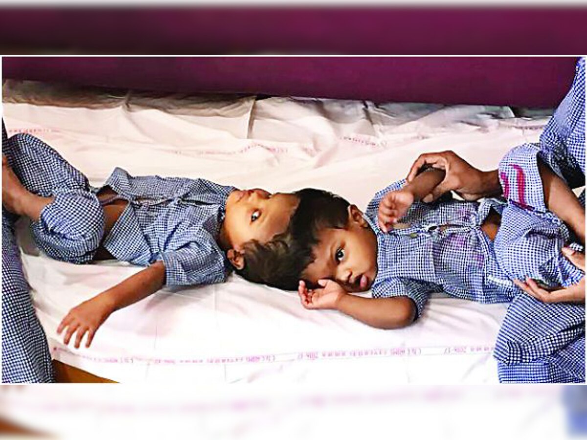 Two 8-hour long rehearsals on polylactic acid model saved craniopagus twins at AIIMS