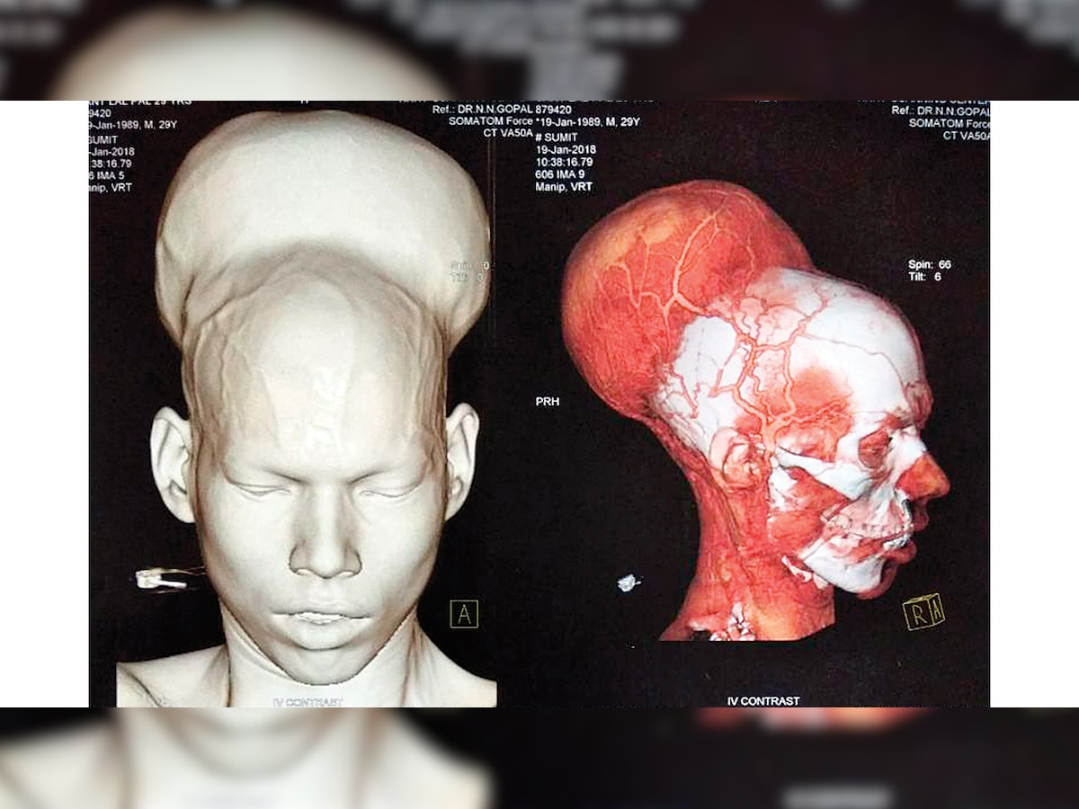 Nair Hospital doctor removes ‘heaviest’ 1.87-kg brain tumour