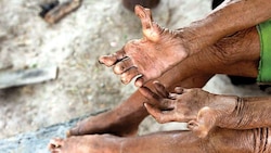 Mumbai: Leprosy patient turns good samaritan for hospital mates