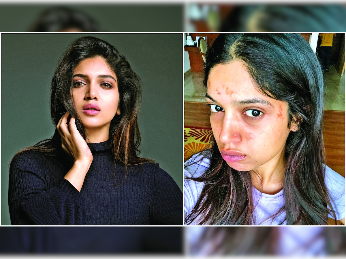 Bhumi Pednekar’s blister tales!