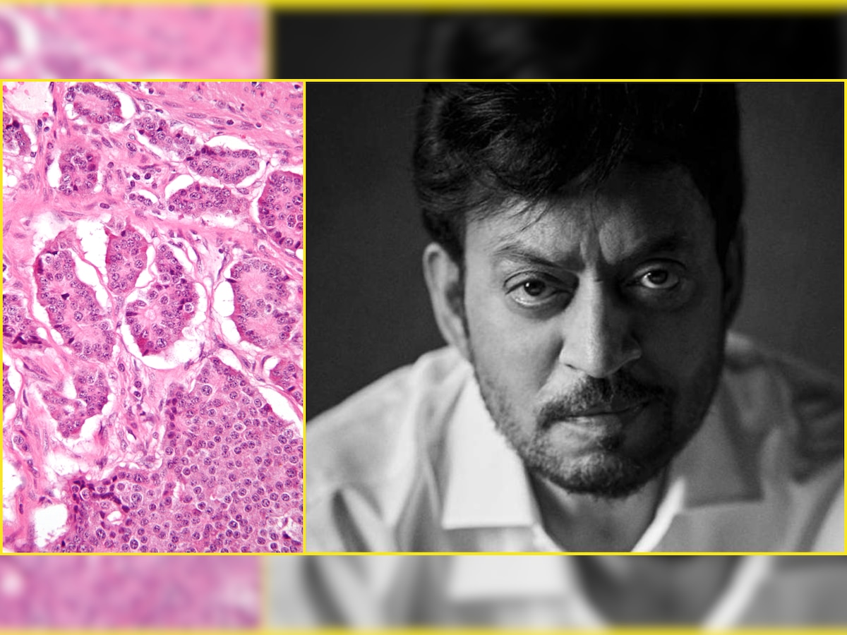 Neuroendocrine tumour (NET): Explaining the disease that killed Irrfan Khan; here's causes, symptoms, treatments