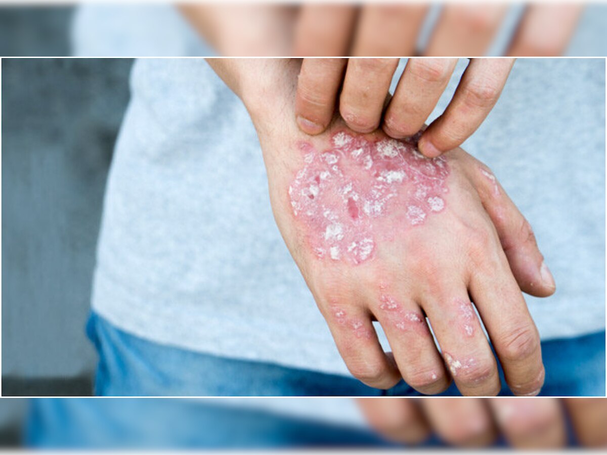 World Psoriasis Day: Know all about symptoms, causes, cure for the 'skin disorder'