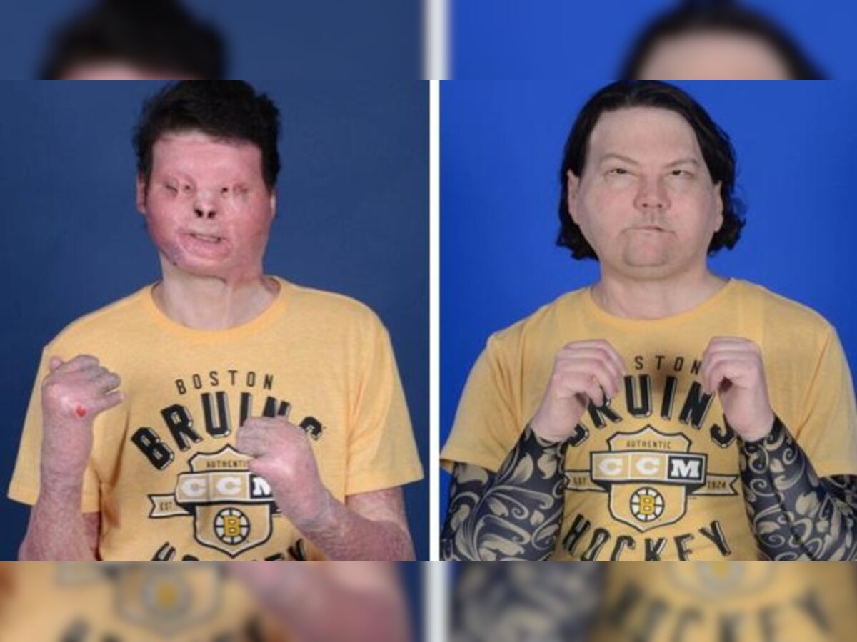 In a first, man receives successful face and hand transplant