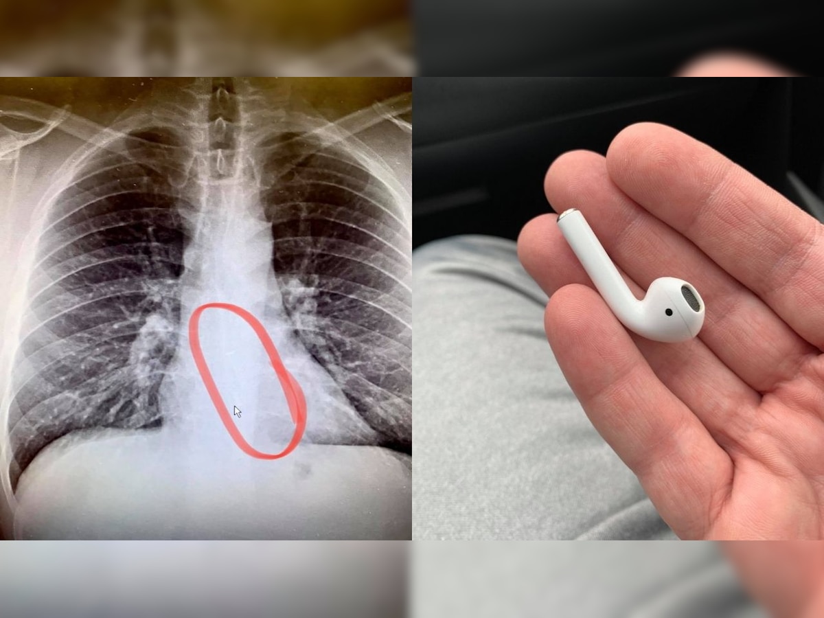 Man swallows Apple airpod in sleep, here's what happened next