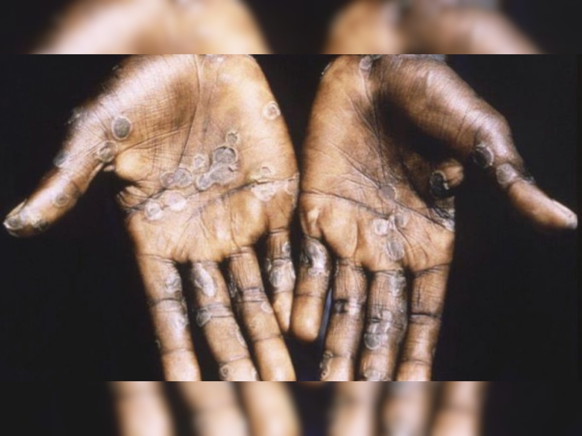 What is monkeypox? The virus affecting people in UK