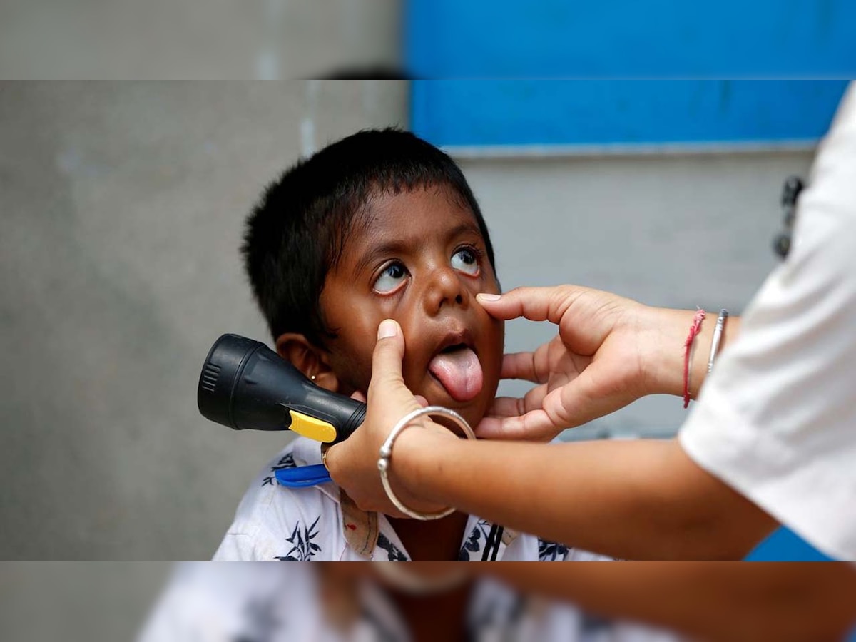 Eyes of three children infected with Black Fungus removed in Mumbai, 16-year-old develops fungus in stomach