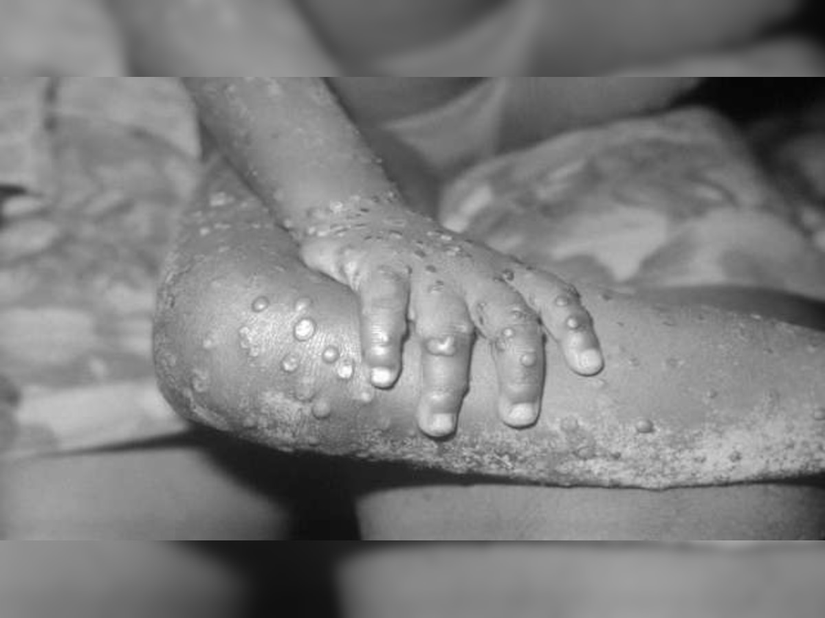 US reports monkeypox case first time in nearly 20 years - What are symptoms and treatment of deadly infection