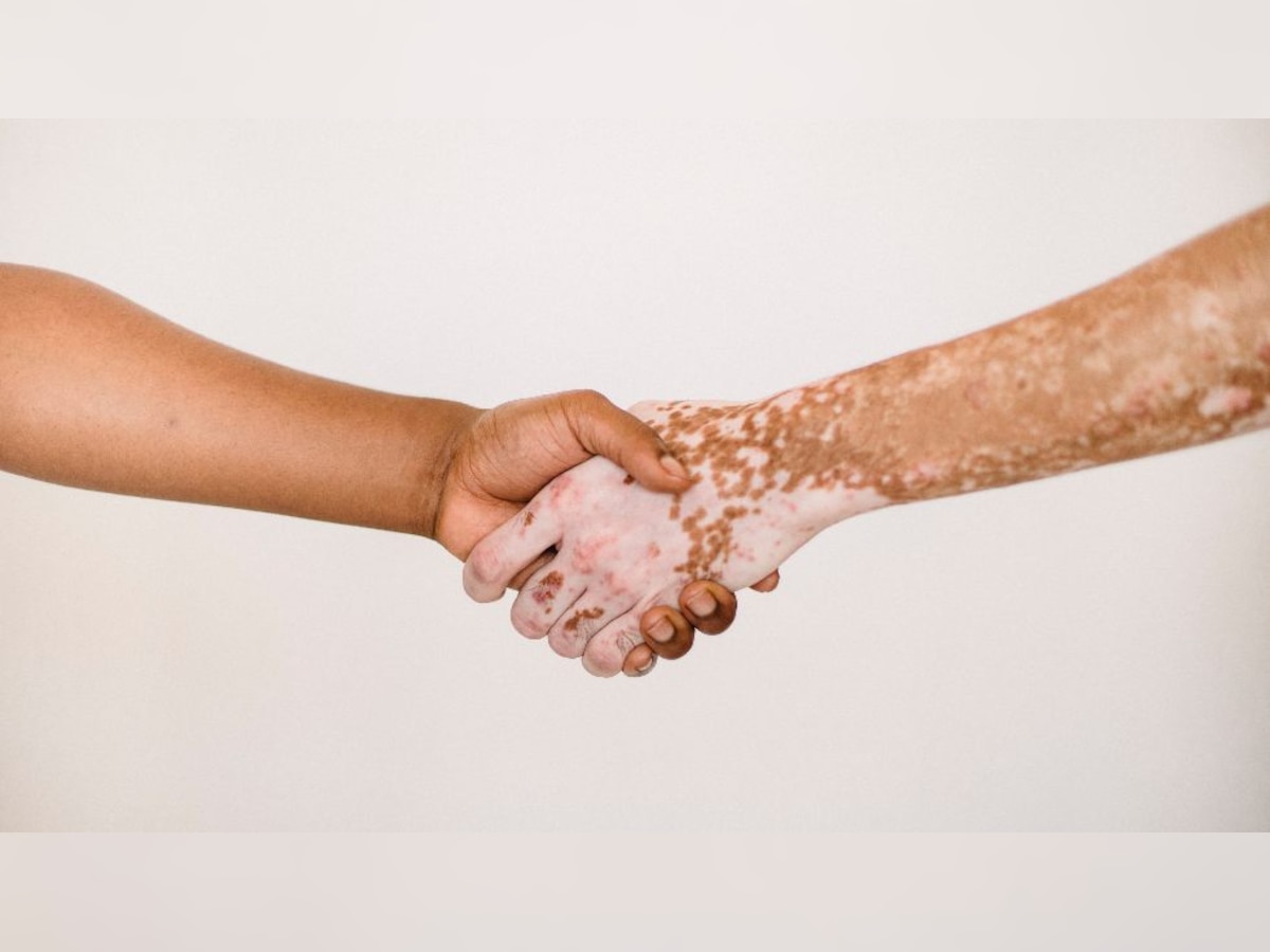 DNA Explainer: What is Vitiligo? Know the truth about the highly stigmatized skin condition