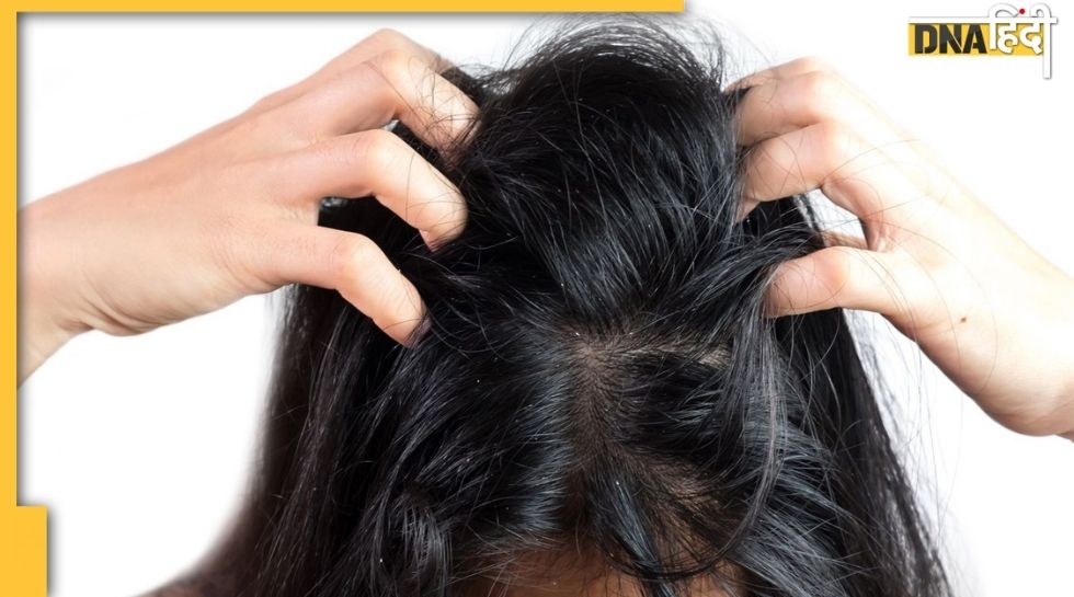 How to Get Rid of Lice Naturally 5 Steps  Home Remedies