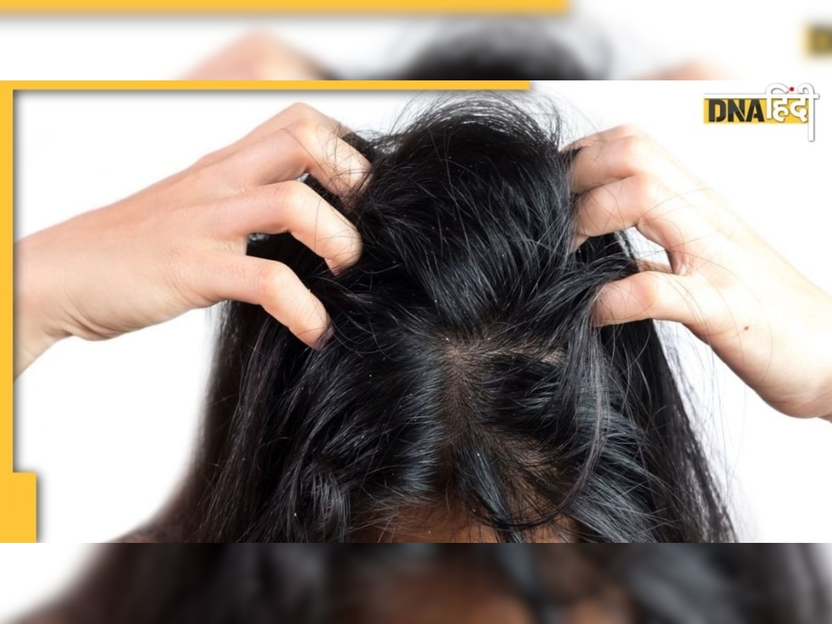 क्या होती है Dandruff ? कैसे सिर पर हो जाता है इसका कब्जा ?