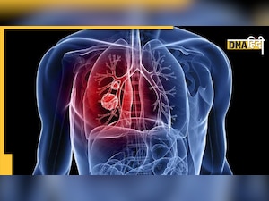 Health News: उत्तर भारत में पहली बार एक साथ हुआ दोनों फेफड़ों का ट्रांसप्लांट, अहमदाबाद से दिल्ली आई सांसों की डोर