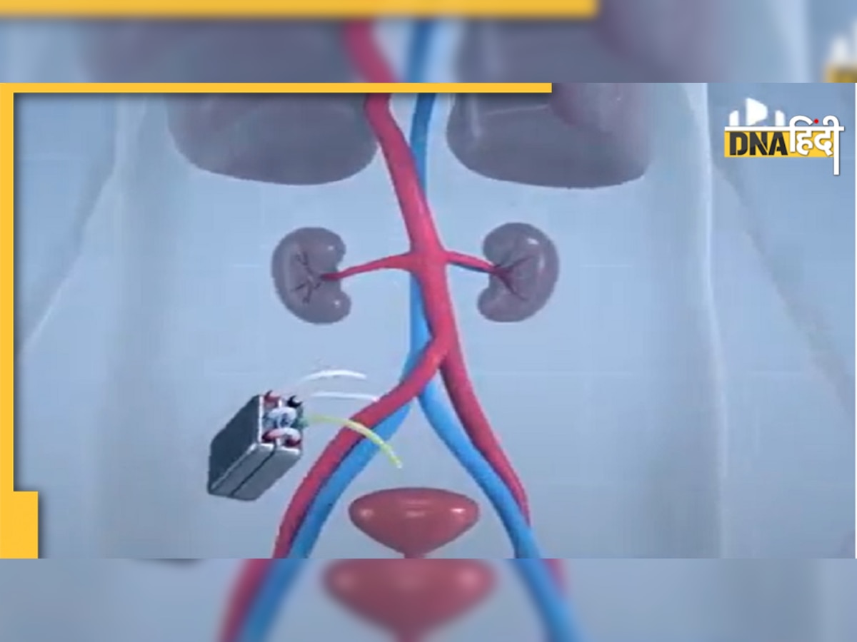 किडनी की बीमारियों में मिल सकती है बड़ी मदद, वैज्ञानिकों ने तैयार की Artificial Kidney