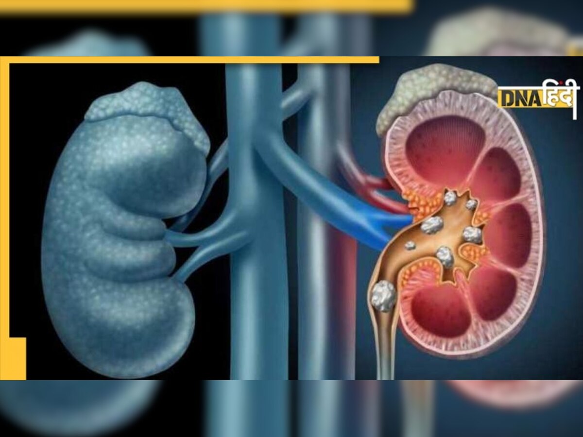 Kidney खराब है तो बढ़ सकता है कैंसर का खतरा, डाइट का रखें खास ख्याल, इन चीजों को ना करें नजरअंदाज