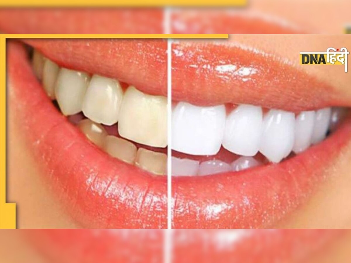 Yellow Teeth Remedies: दांतों के पीलापन से हैं परेशान? इन 5 तरीकों से बचाएं डेंटिस्ट का खर्चा