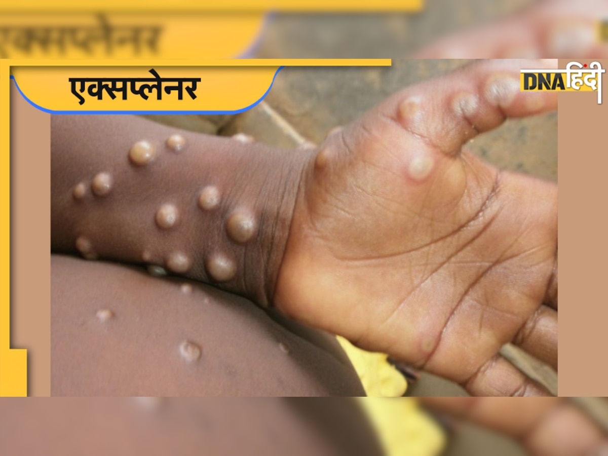 Monkeypox : मौत का सौदागर बन रही है यह बीमारी, जानिए किन लक्षणों से इसे पहचान सकते हैं?