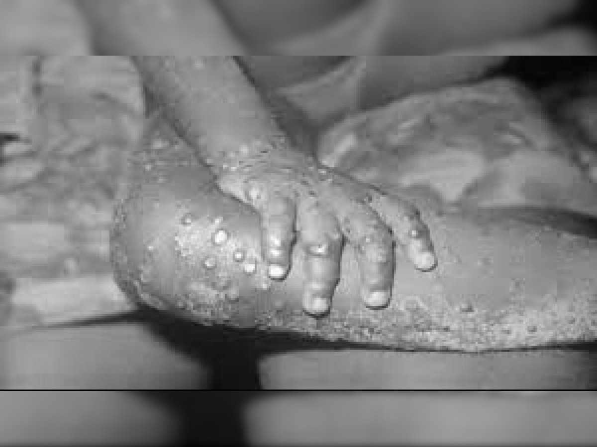 Monkeypox: 2 more cases found in London; what are the symptoms, treatment of dreaded disease