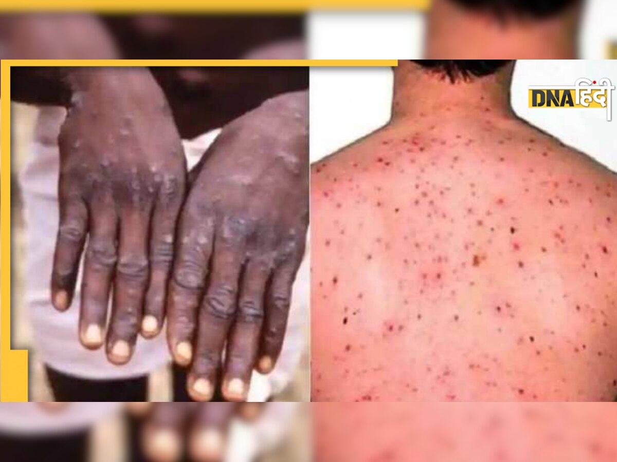 Monkeypox : होमोसेक्सुअल लोगों को अधिक alert रहने की सलाह 