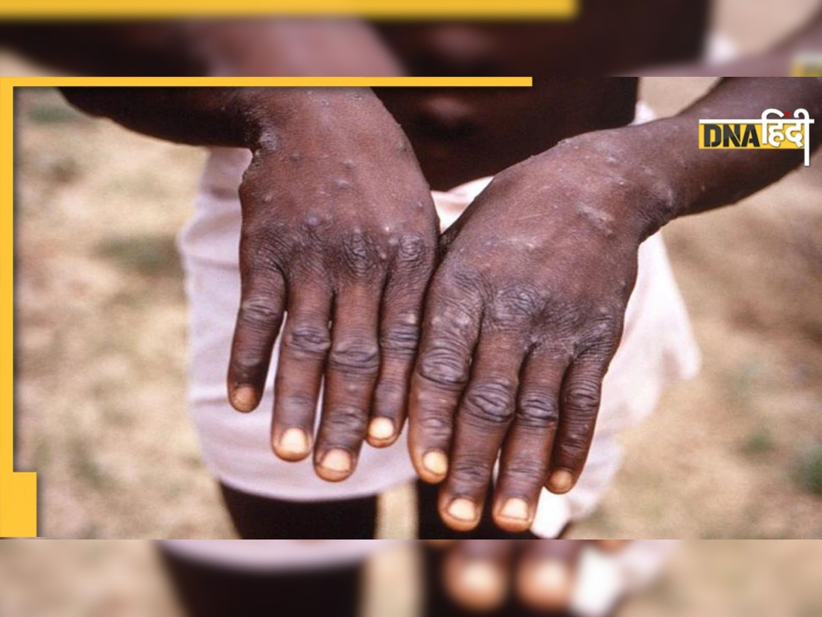 Monkeypox: अमेरिका में मिला मंकीपॉक्स का पहला मरीज, ब्रिटेन और यूरोप में भी फैला वायरस