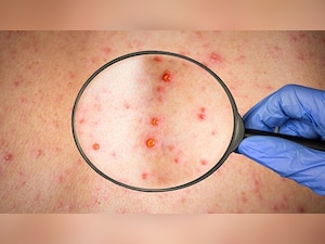 Monkeypox cases crosses 100 in Europe, WHO calls emergency meeting