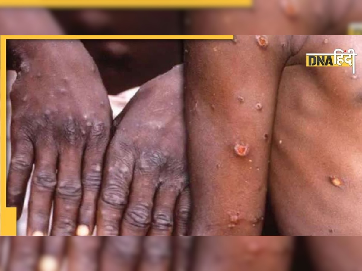 Monkeypox Virus: सेक्स के कारण तेजी से फैला मंकीपॉक्स, WHO ने दी क्या चेतावनी?