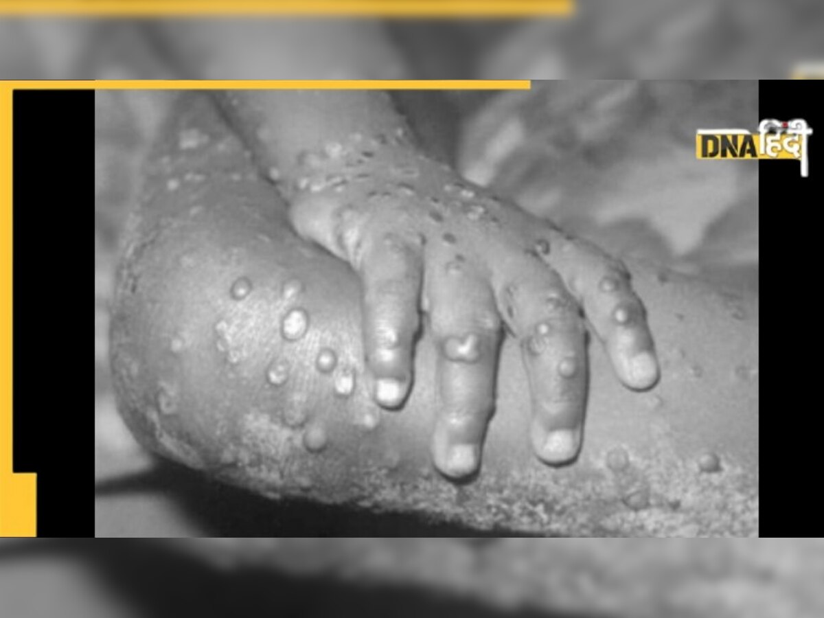 Monkeypox: बांग्लादेश ने घोषित किया हेल्थ अलर्ट, 12 देशों में 92 मामले दर्ज, जानें लक्षण और बचाव