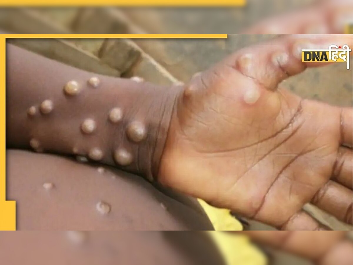 Monkeypox के इलाज में कारगर हैं ये दो दवाएं, रिसर्च में सामने आई ये बड़ी बातें