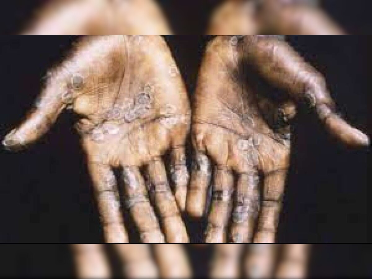 Monkeypox alert! Uttar Pradesh to monitor people with international travel history