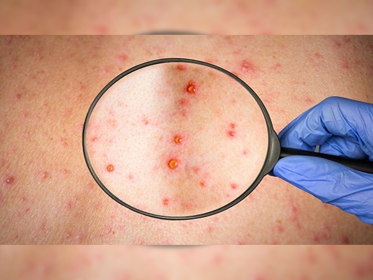 Monkeypox outbreak: Disease presents moderate risk to global health, says WHO