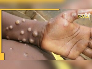 Monkeypox Advisory: मंकीपॉक्स को लेकर योगी सरकार अलर्ट, जारी की एडवाइजरी