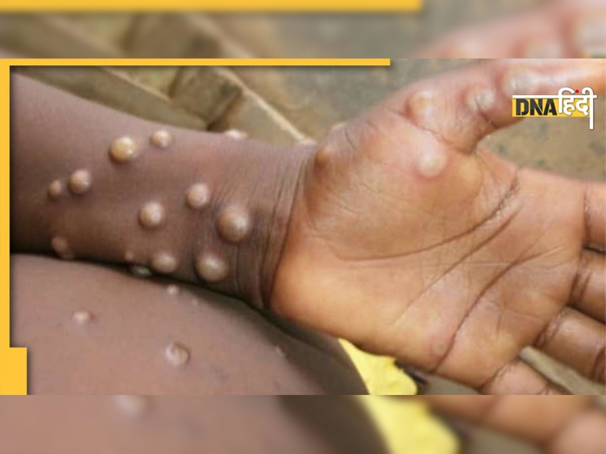 Monkeypox: रुड़की में मंकीपॉक्स का संदिग्ध मरीज, जांच के लिए भेजी गई मेडिकल टीम