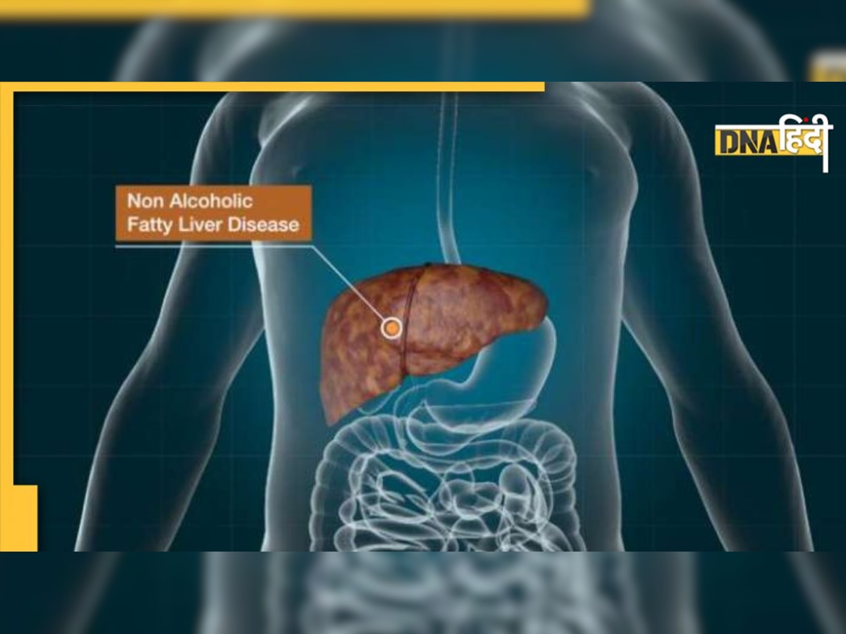 Fatty Liver Disease: फैटी लिवर के मरीजों के लिए कमाल के उपाय, न्यूट्रिशनिस्ट ने दिए ये टिप्स