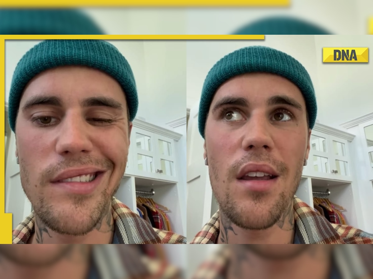 Justin Bieber shows signs of improvement after being diagnosed with Ramsay Hunt syndrome